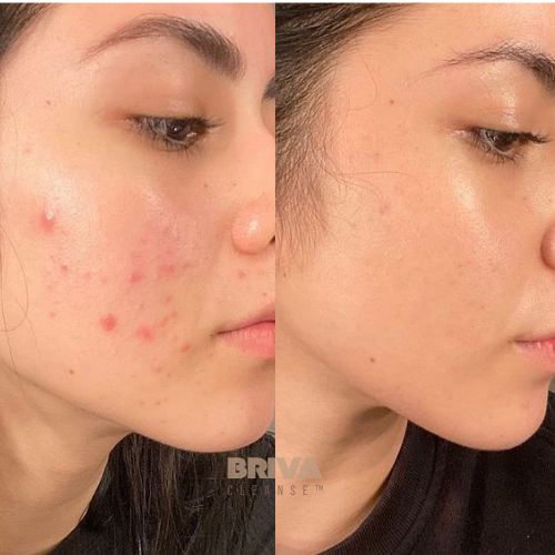 Briva Cleanse™
